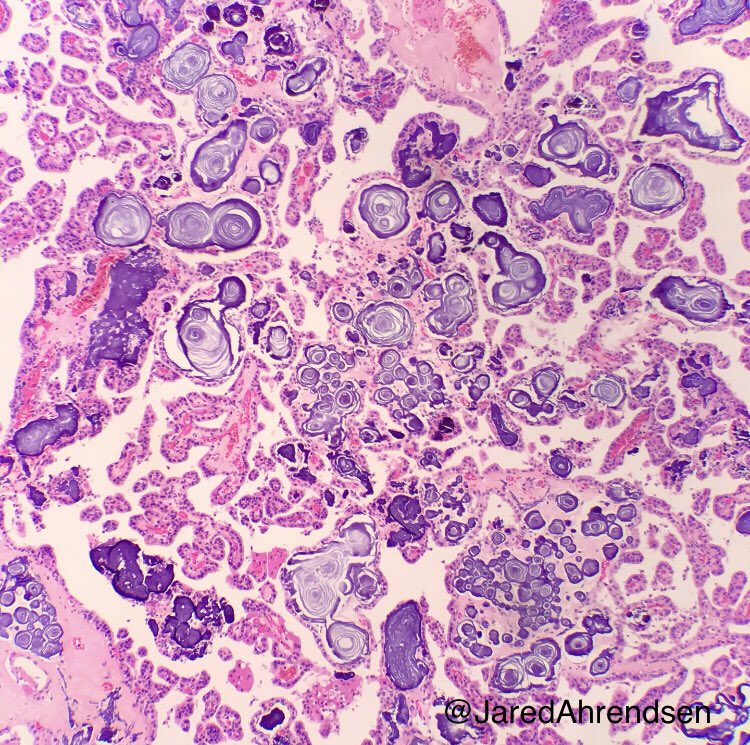 JaredAhrendsen's tweet photo. Psychedelic calcifications in this large but benign choroid plexus papilloma with <2 mits/10 HPF, no necrosis, and bland appearing cuboidal cells arranged in papillae. 🧠 #neuropath #pathart https://t.co/tB9GwRZwUB