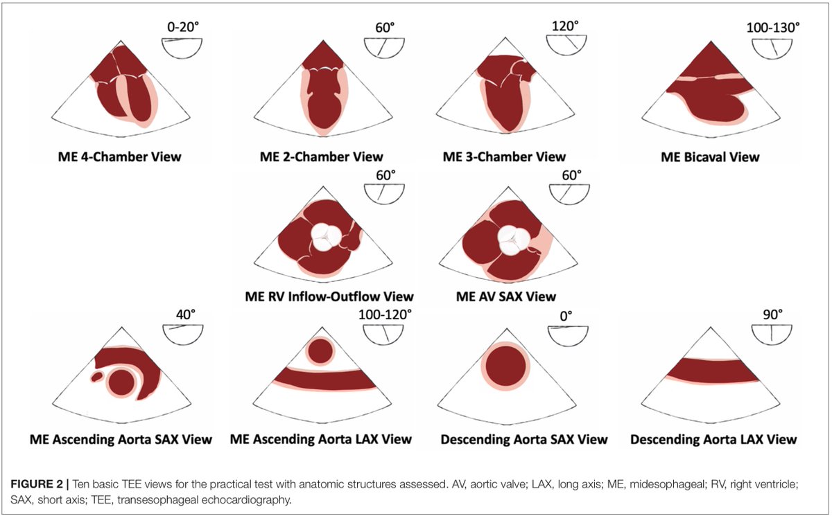 PezelT's tweet photo. 🎯So glad to share our Design Paper of the #SIMULATOR Study just published in @FrontiersIn! 

Multicenter Randomized study of > 300 Cardiology Residents to assess the impact of Simulation Training on TEE learning throughout France🇫🇷!! 

📲 Open-access https://t.co/Lah2PCXGGL https://t.co/VwRfK0uHu1
