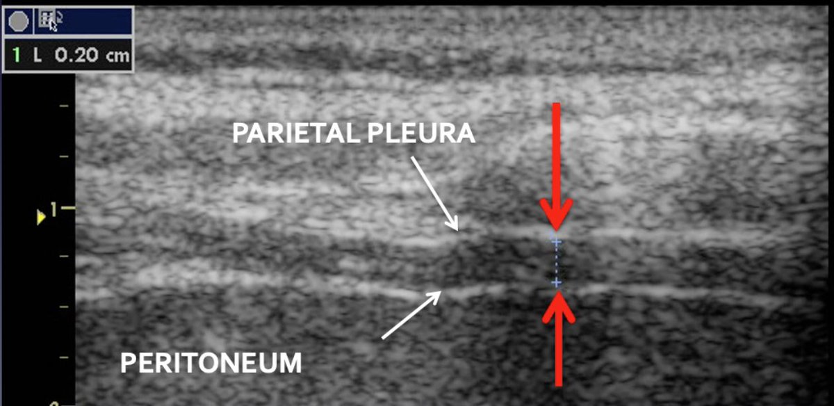 Essential of lung/diaphragm #POCUS tutorial 🧵
🦇 sign identify lung in ICS (ribs acoustic shadows)
__...