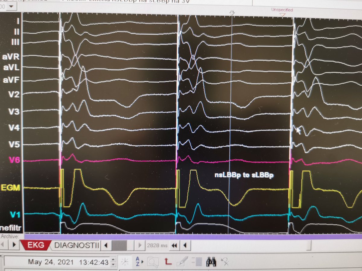 curilakarol (@curilakarol) on Twitter photo Dual lead technique <a href="/MdHuang/">Weijian Huang</a> <a href="/Dr_Sulan/">Su Lan. MD</a> is the method which helped me the most in the beginnings of LBBAP. Shows the region of interest, the lead depth in the septum and you can still choose from 2 physiological pacing modes. Which one was yours favourite? Dual lead technique <a href="/MdHuang/">Weijian Huang</a> <a href="/Dr_Sulan/">Su Lan. MD</a> is the method which helped me the most in the beginnings of LBBAP. Shows the region of interest, the lead depth in the septum and you can still choose from 2 physiological pacing modes. Which one was yours favourite?