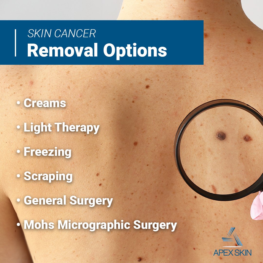 Did you know that there are several different ways to remove skin cancer? Your dermatologist will guide you to the best option for you.

You can read the full blog here: buff.ly/2SkS41a

#skincancerawarenessmonth #mohs #skincancer  #dermatology #cleveland #apexskin