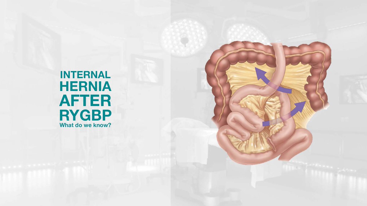 AIS Channel (@aischannel) on Twitter photo 📢Internal Hernia after RYGBP: what do we know?
Surgical Open Classroom by <a href="/AnnaCurell/">Anna Curell</a>, MD General Surgery, Junior Attending, <a href="/hospitalclinic/">Hospital Clínic</a>
aischannel.com/society/intern…
#SurgicalEducation #surgical #surgery #medicine #hospital #medical #healthcare #health #aischannel 📢Internal Hernia after RYGBP: what do we know?
Surgical Open Classroom by <a href="/AnnaCurell/">Anna Curell</a>, MD General Surgery, Junior Attending, <a href="/hospitalclinic/">Hospital Clínic</a>
aischannel.com/society/intern…
#SurgicalEducation #surgical #surgery #medicine #hospital #medical #healthcare #health #aischannel