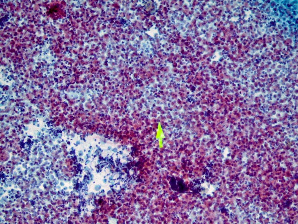 israhkhan's tweet image. #pulmonarypath #crittersontwitter BAL with blastomyces. #cytopath #cytology
BBB- broad based budding yeast, Southwestern US
D/D Cryptococcus- which has more variability in size
