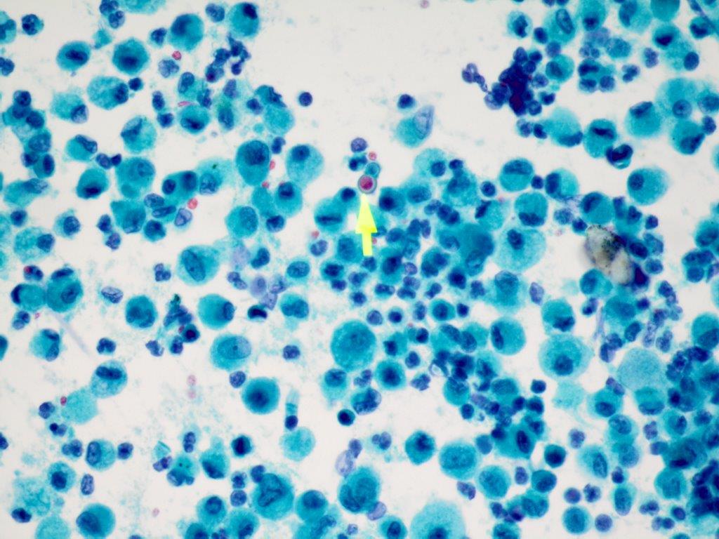 israhkhan's tweet image. #pulmonarypath #crittersontwitter BAL with blastomyces. #cytopath #cytology
BBB- broad based budding yeast, Southwestern US
D/D Cryptococcus- which has more variability in size