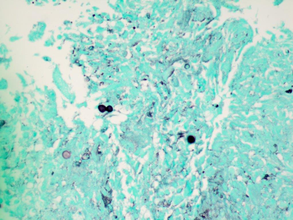 #pulmonarypath #crittersontwitter BAL with blastomyces. #cytopath #cytology
BBB- broad based budding yeast, Southwestern US
D/D Cryptococcus- which has more variability in size