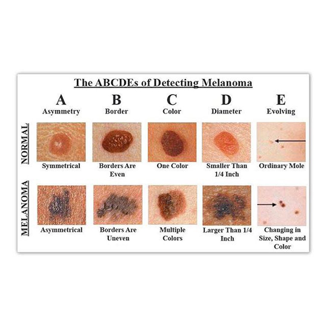 DulwichPodiatry's tweet image. SKIN CANCER: Signs to look out for 🔍 Image from: tinyurl.com/4eree49t #dulwichpodiatry #skinawareness