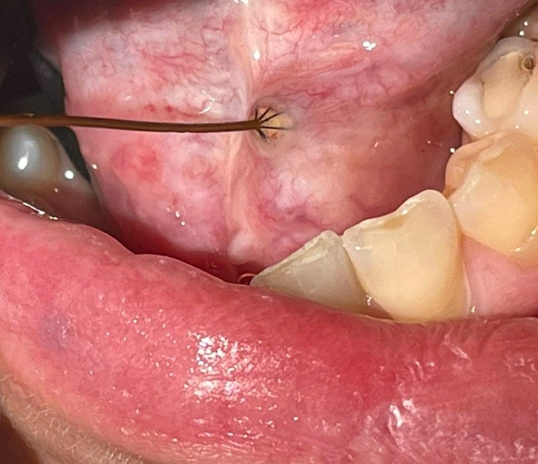 HablemosdeOrl's tweet photo. Los cálculos (piedras) salivales son una de las causas de la #sialoadenitis obstructiva crónica.
La #sialoendoscopia es la solución mínimamente invasiva para su extracción. https://t.co/BYlMn8rAgu
