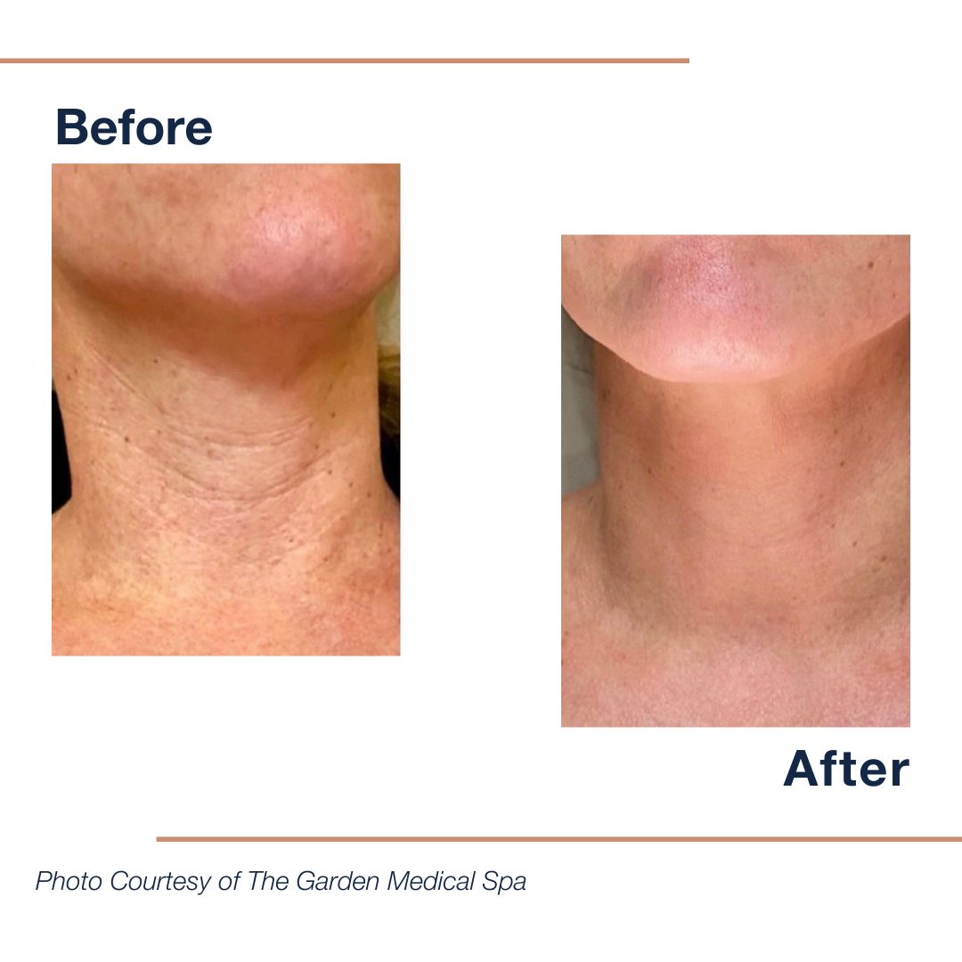 LumenisIndia's tweet photo. Age defying results, right this way ➡️
.
The #LegendPro combines unique synergetic technologies to smooth wrinkles, tighten skin and give you that fresh, youthful look. [📸: The Garden Medical Spa] https://t.co/6Q6eQDkDAZ

#LegendPro #DareToImagine #skin #VoluDerm #TriPollar https://t.co/lurLblmgJf