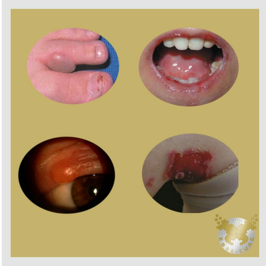 EBee_Cure's tweet photo. Epidermolizis Bülloza Belirtileri/
Symptoms of Epidermolysis Bullosa
✨  👇TR/ENG👇

#ebawareness #epidermolysisbullosa #epidermolizisbülloza #epidermolisebolhosa
#butterflydisease #butterflychildren
#kelebekhastalığı #kelebekçocuklarımız
@RaDiChallenge @CihanTastan_PhD https://t.co/ARkI50iOsP
