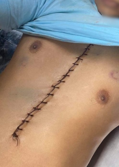 #May25Coup Myotha Ward, Kalay

TORTURE AND DEATH IN DETENTION

Unmistakeable signs of torture. Chest and abdomen opened. 

Ko Min Min was abducted yesterday. See my previous tweet 

#WhatsHappeningInMyanmar #Myanmar
