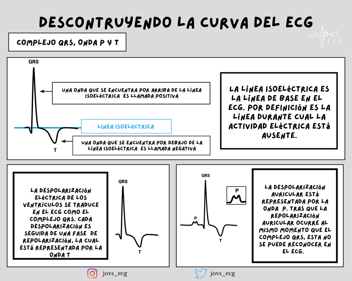 Jovs_ecg's tweet photo. #qrscomplex #pwave #twave #jovs_ecg https://t.co/mv5hFTTWV5