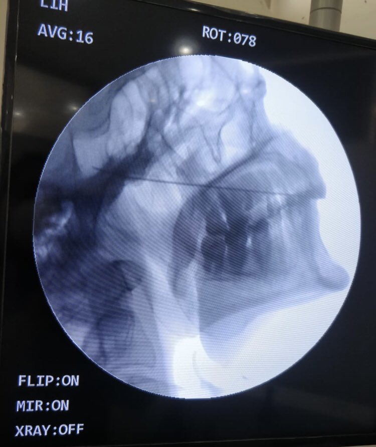 tariqtramboo's tweet image. #Trigeminal Neuralgia(TN) (also known as the Suicide Disease). Intermittent facial pain is such that if untreated patients may commit suicide. Gasserian ganglion ablation is the treatment of choice. We select the painful nerve and ablate it safely. Did one today with 100% results