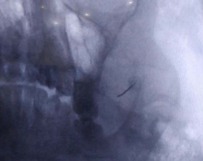 tariqtramboo's tweet image. #Trigeminal Neuralgia(TN) (also known as the Suicide Disease). Intermittent facial pain is such that if untreated patients may commit suicide. Gasserian ganglion ablation is the treatment of choice. We select the painful nerve and ablate it safely. Did one today with 100% results