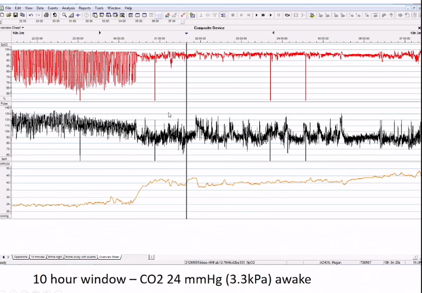 LondonPaedResp's tweet image. Very prolonged breath-holding seen after hyperventilation.

sciencedirect.com/science/articl… - TM

#paedresp2020 @LondonPaedResp