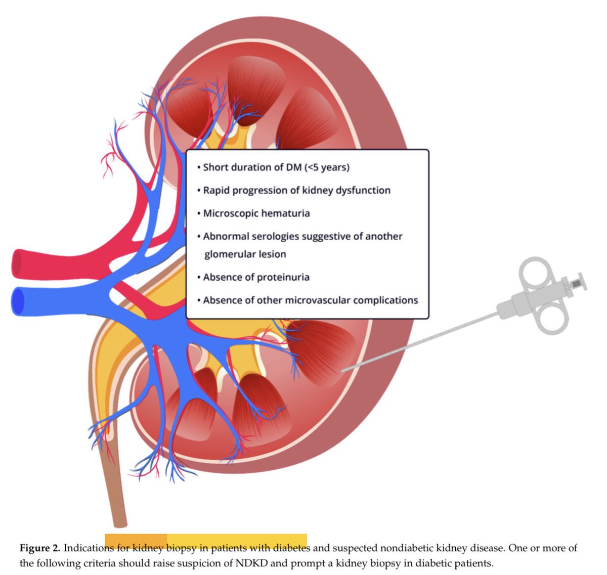 Se estima que hasta el 33% de los pacientes con diabetes y enfermedad renal podrían tener otra glomerulopatia tratable, aquí sugerencias de cuándo sugerir una biopsia.

J. Clin. Med. 2021
doi.org/10.3390/ jcm10091855