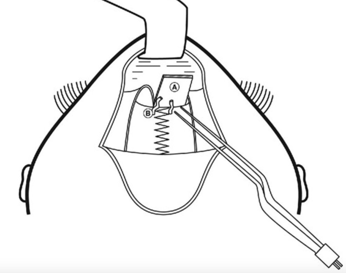 NeurosurgeryCNS's tweet photo. #ONSNew A Case Series of the Use of Piezosurgery Instrument for Minimally Invasive Metopic Suturectomy https://t.co/3OSyeb0efH by McGahan et al @OhioStateMed
#Nsgy #Craniosynostosis #Metopic #Minimallyinvasive #Piezosurgery https://t.co/gtu7BzA5lO