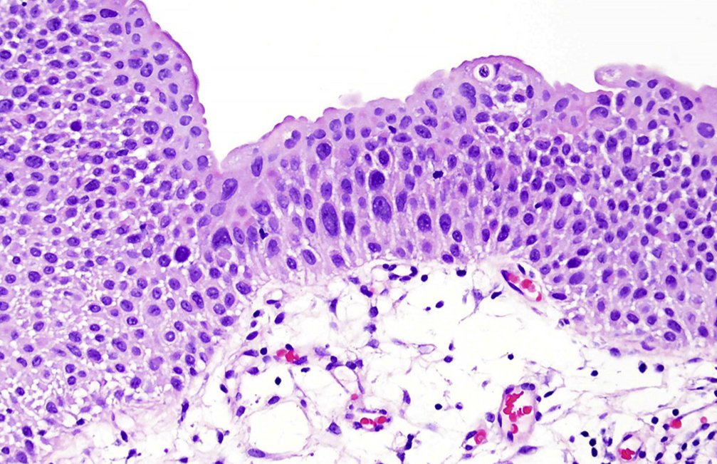Human_Pathology's tweet photo. #HumPathol #RecentArticle

@Andres_Matoso et al. address difficulties in grading noninvasive low-grade papillary urothelial carcinoma with significant nuclear pleomorphism and degenerative atypia #GUPath #Pathology https://t.co/Bi6fsuKq40