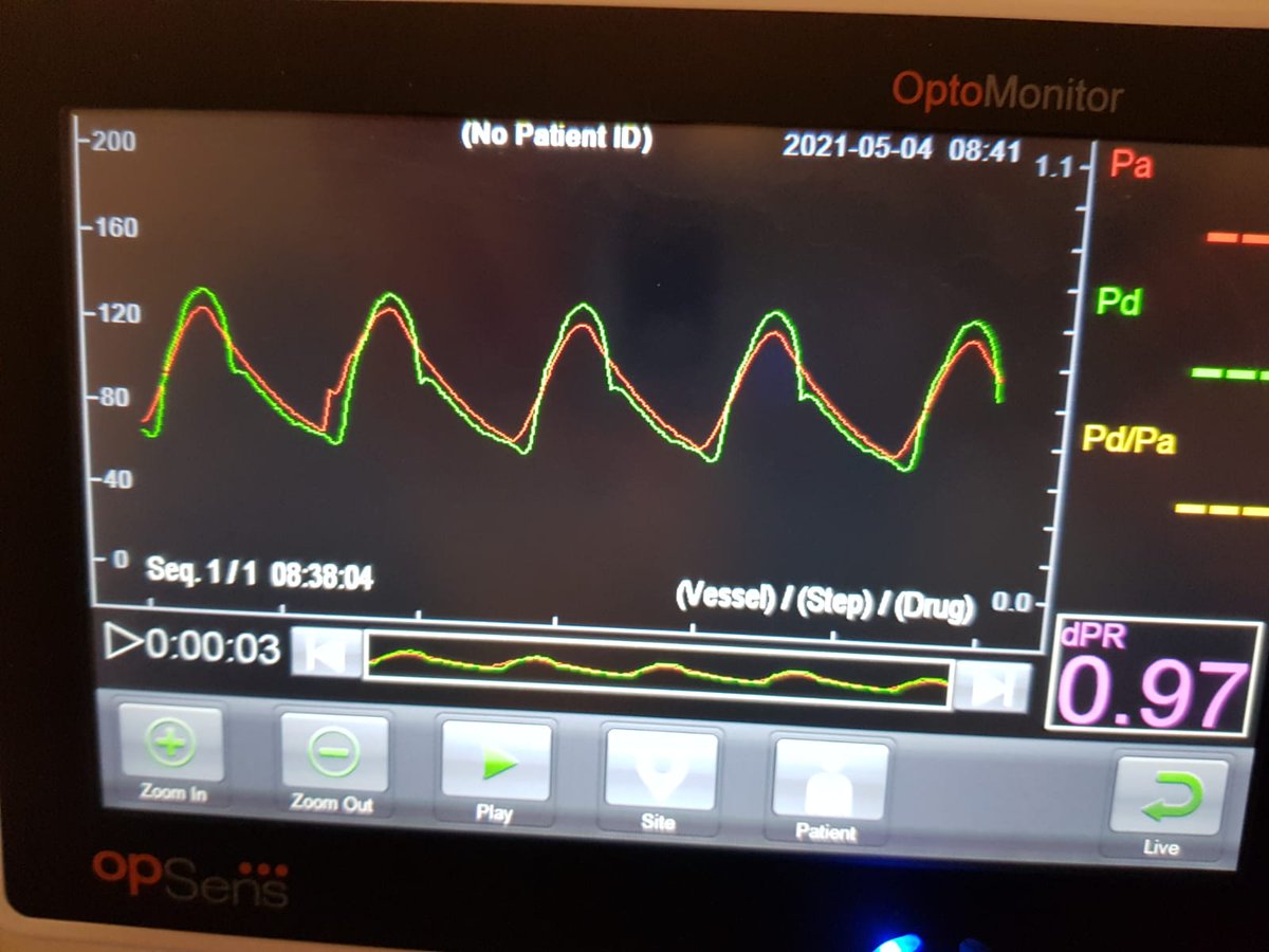 Congrats to Jan Sitar of University Hospital St. Anna in Brno for his 1-wire PCI case report!

Patient was found with stenosis on proximal LAD and on Circumflex artery. #OptoWire III was used to cross the lesion on LAD after successful assessment
#Nodrift <a href="/AllInCoroPhy/">All In Coronary Physiology</a>