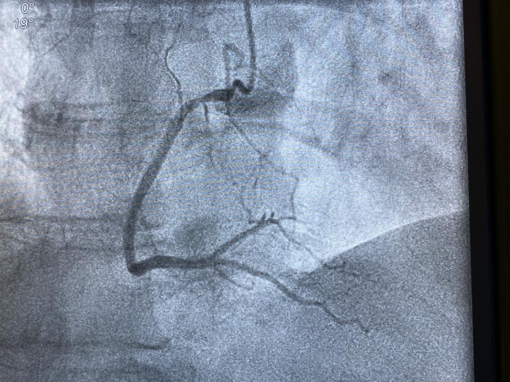 HAEQuebec's tweet image. Congrats to Jan Sitar of University Hospital St. Anna in Brno for his 1-wire PCI case report!
 
Patient was found with stenosis on proximal LAD and on Circumflex artery. #OptoWire III was used to cross the lesion on LAD after successful assessment
#Nodrift @AllInCoroPhy
