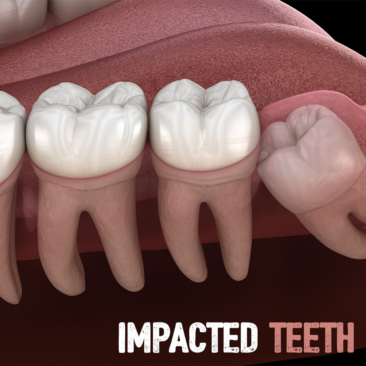 Dentistry Terms &amp; Definitions: Impacted

An impacted #tooth is one that has insufficient room to erupt through the gums. This can occur with any teeth, but is most commonly witnessed in wisdom teeth. #generaldentistry