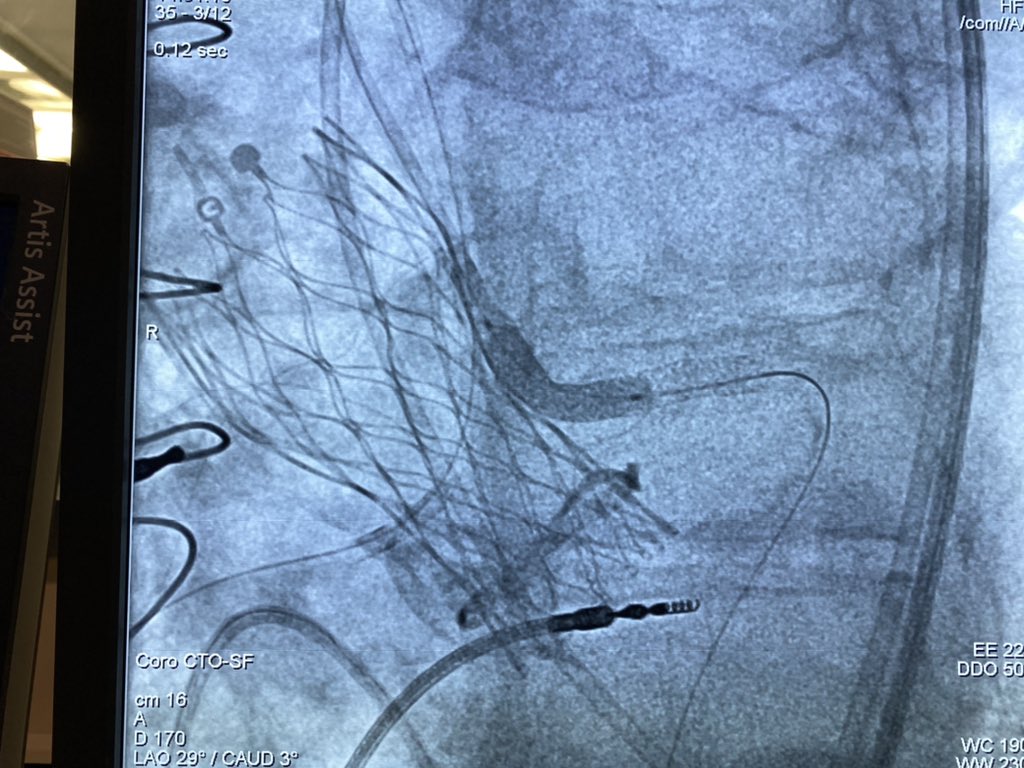 Combined bioprosthetic valve fracture (Crown n.19) and chimney stenting in valve-in-valve TAVR (Evolut R n.23).