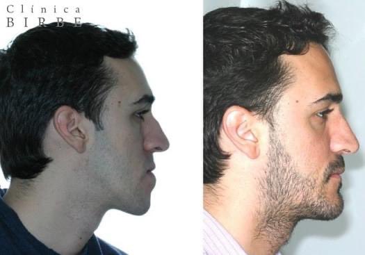 Otro caso más de cirugía ortognática 🔝🔝 #maxilofacial #cirugiaestetica  #odontologia #esteticadental #carillas #ortognatica #rinoplastia #liplift #cirugiafacial #esteticafacial #clinicabirbe #birbe #dentista #implantesfaciales #implantes #cirugiaparpados #mentoplastia