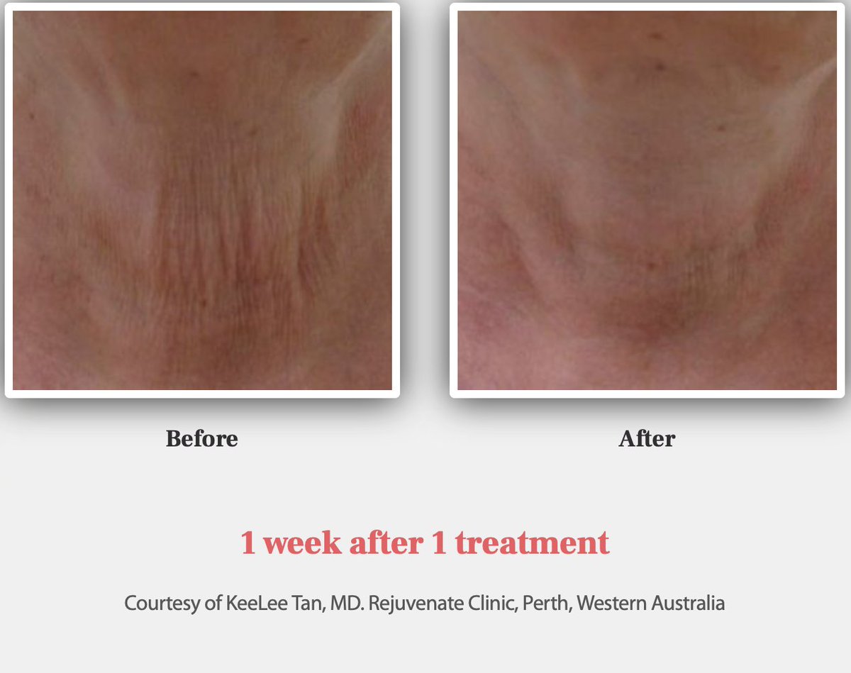 ClearSkyMed's tweet photo. One of our favorite treatments tackles brown spots, sagging skin and fine lines. Plus, it can be used on nearly any part of your body, it is very well tolerated and has no downtime! What could be better than a Clear Lift treatment?? It’s a lunch lift!  👏🏻  #clearlift #nodowntime https://t.co/spbyGfouK4