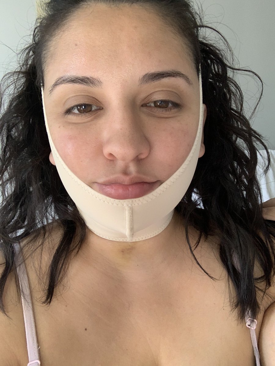 KissMyBigFatAss's tweet photo. In order to add more definition to my face after my #chinlipo I bought a #compressiongarment from #Aurafix and this #firmingcream from #AnacisVelaContour... beauty don’t hurt but the maintenance is a mofo https://t.co/Y5QTit9K2f