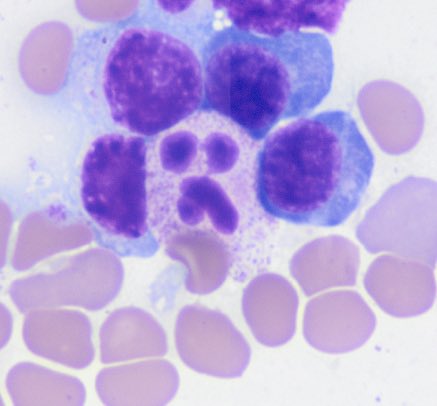 TFW your personal space is invaded. Neutrophils are so dramatic 🎭 #hemepath
