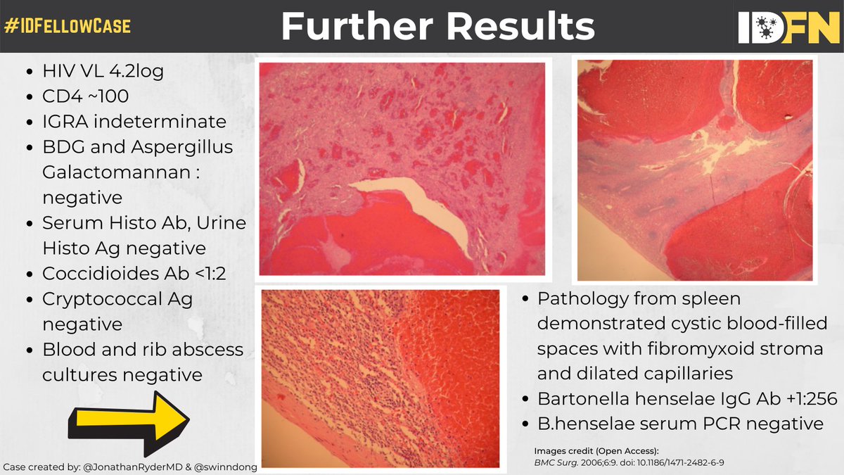ID_fellows's tweet photo. #IDFellowCase
So your results are back and we have a final diagnosis!!
A few picked up on the rash, and our splenic biopsy demonstrated peliosis (see pics below)
⭐️⭐️We still need your help, stay tuned for a little learning and more questions!⭐️⭐️ https://t.co/ndwhB5d1st