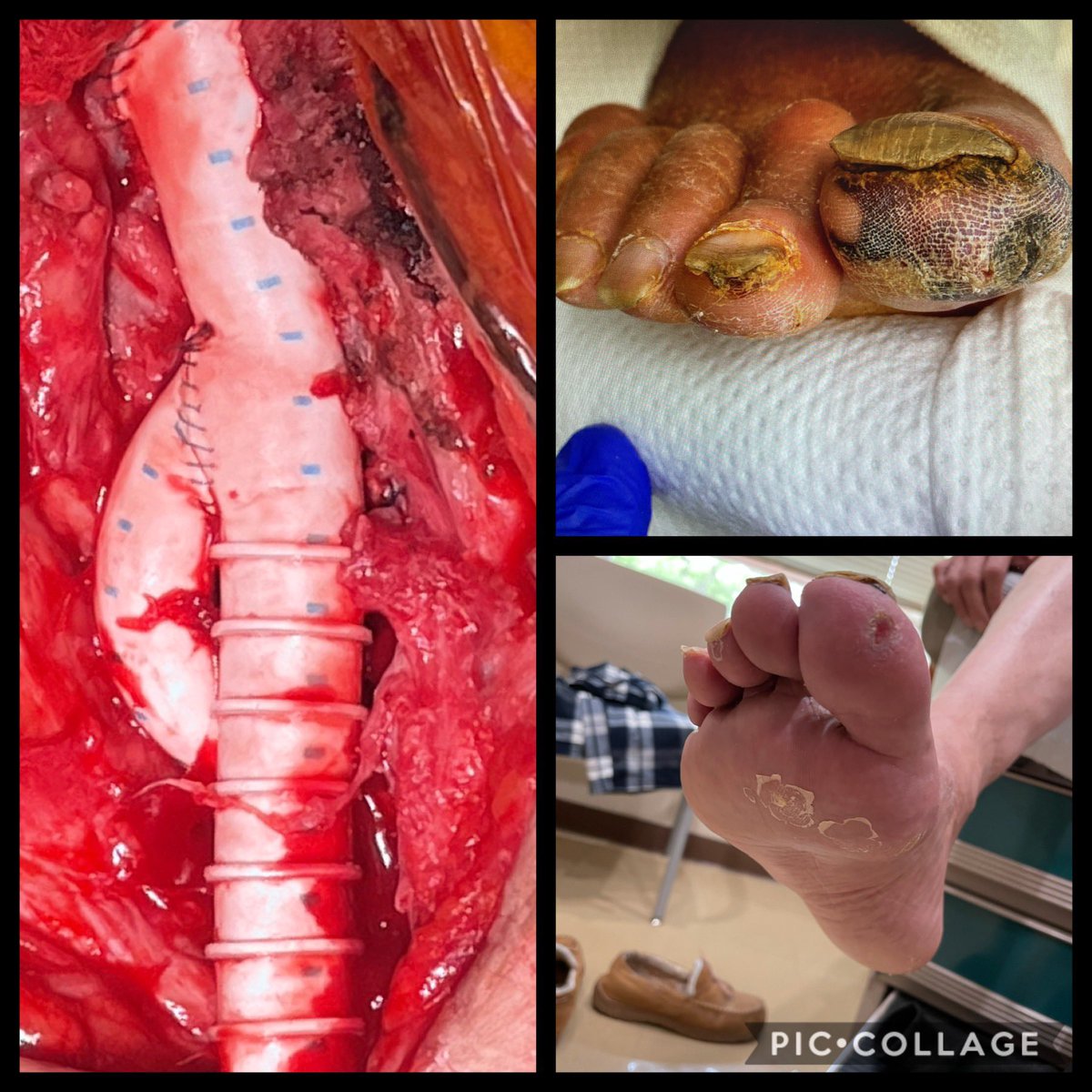 Bruce Tjaden MD (@brucetjadenmd) on Twitter photo Rest pain, toe ulcers; prior #aortobifem with R ABF limb, CFA/PFA, SFA-to-PT occluded. no vein. Did #ABF limb #Thrombectomy and #stentgraft for inflow, then graft-to-PT #bypass, jump bypass to PFA. Pain gone, toes almost healed. #LimbSalvage <a href="/CooperHealthNJ/">Cooper University Health Care</a> Rest pain, toe ulcers; prior #aortobifem with R ABF limb, CFA/PFA, SFA-to-PT occluded. no vein. Did #ABF limb #Thrombectomy and #stentgraft for inflow, then graft-to-PT #bypass, jump bypass to PFA. Pain gone, toes almost healed. #LimbSalvage <a href="/CooperHealthNJ/">Cooper University Health Care</a>