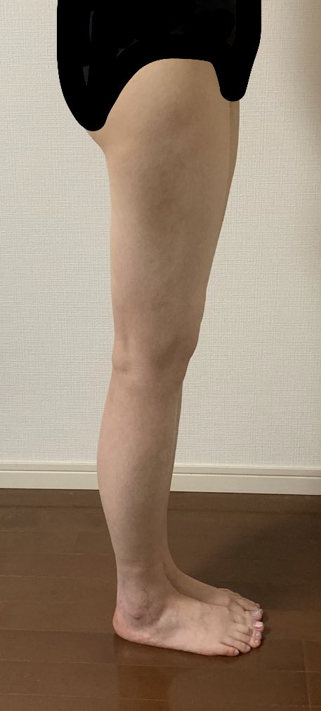 のん 7月目元脱脂 Mcrf 太腿脂肪吸引 Dt24日目 本当に特に変わらない日々 胸だけは吸収を感じている まだ触ると 痛みはあると考えると 腹部と腰は結構しんどいのかな
