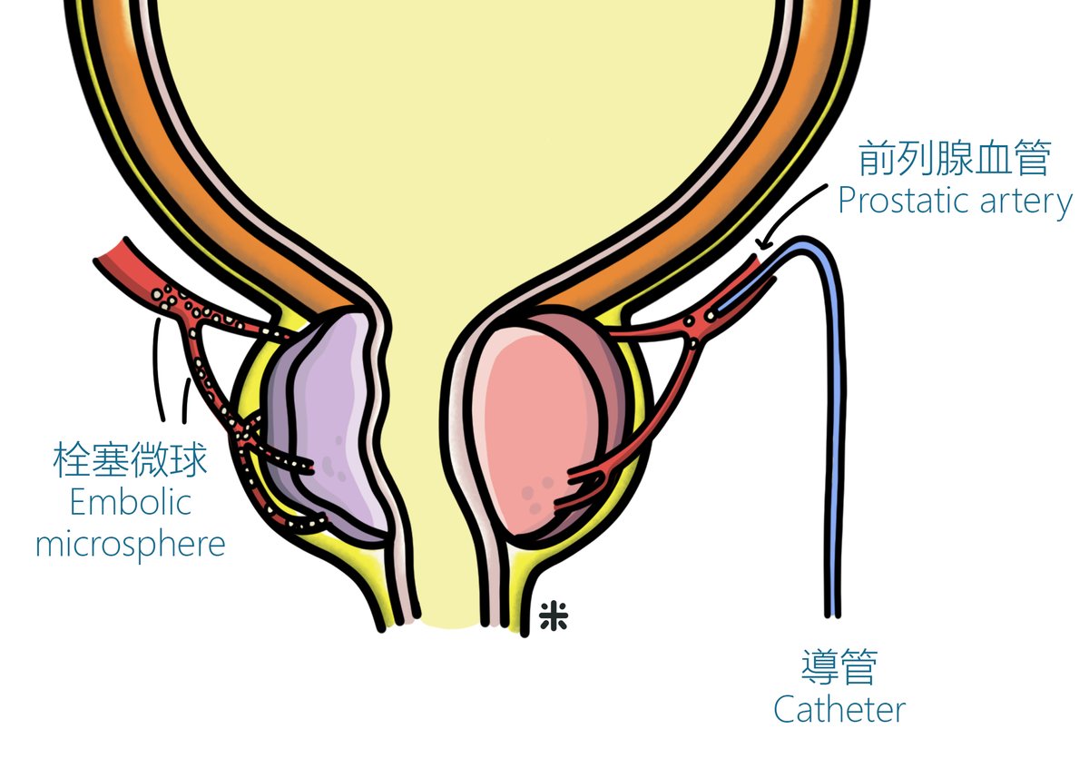 [#CUHKUrology] A recent CUHK research indicates that more than 80% of BPH/LUTS patients have alleviated lower urinary tract symptoms after receiving prostatic artery embolization. Details: bit.ly/33znnHW 
Illustration by <a href="/bowlful/">Brian Dell</a>.of.rice