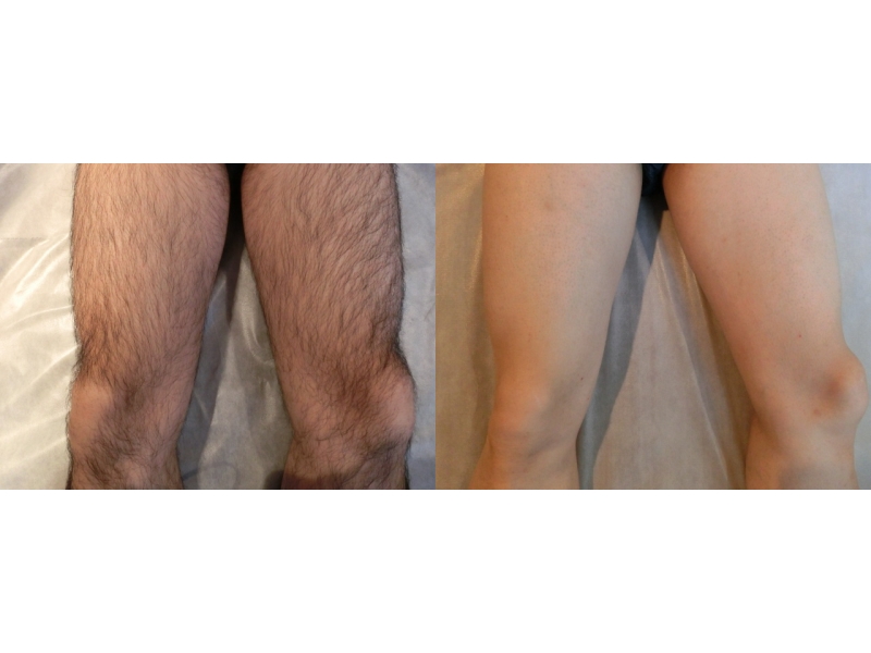 足の脱毛 Twitter Search Twitter