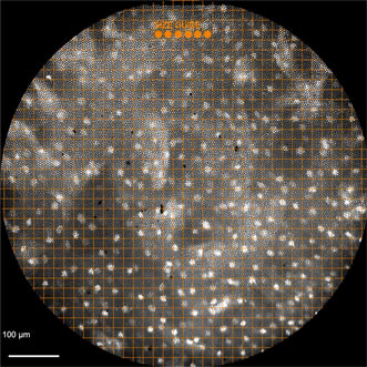 scitechnol.com/research-journ…
A low-cost, portable,battery-powered #microendoscope could reduce the need for costly biopsies for many patients.Conclusion of researchers behind a clinical study involving 147 patients in U.S.and China at high risk for esophageal squamous-cell neoplasia.