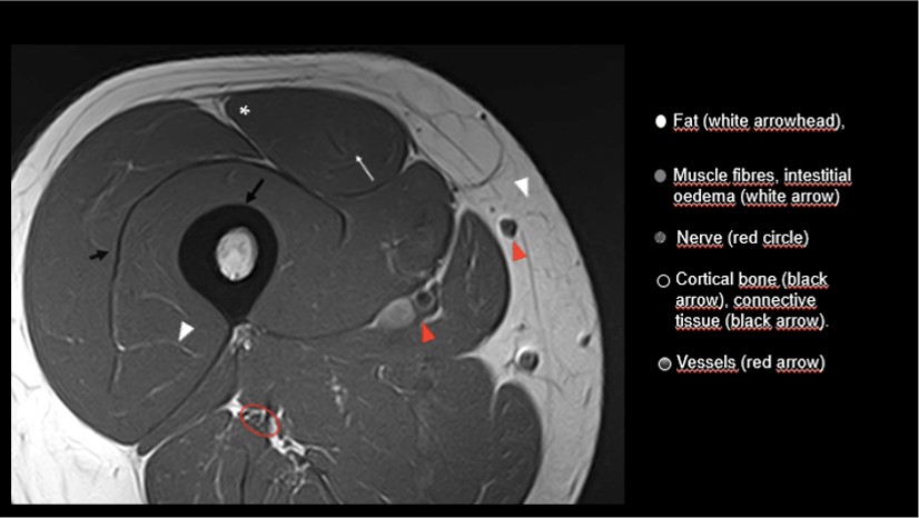 Muddled by MRIs? Do the slices drive you STIR-crazy? 

A Beginners Guide to Musculoskeletal MRI #Blog courtesy of <a href="/carlespedret/">carlespedret</a> <a href="/mechomeca/">Sandra</a> - now at >6500 views!

ow.ly/38hF50ETDN2