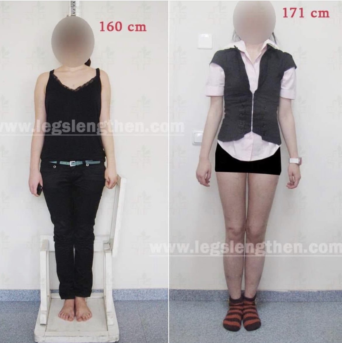 Gen 身長をカネで買った医者 Gen Ilizarov Twitter