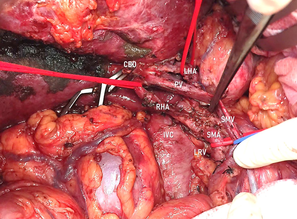JeancarTrujillo's tweet photo. Our first TRIANGLE OPERATION - Radical Surgery for advanced pancreatic head tumour after neoadjuvant therapy!!! #AnatomicalVariant #RHAfromSMA mFolfirinox!  By @mariomontesmd @jezieniecki #H.ClinicoValladolid #M.Rodriguez #A.Delgado @Cirbosque @hpb_so @aecirujanos @smoralesconde https://t.co/EQm9J87YJ5