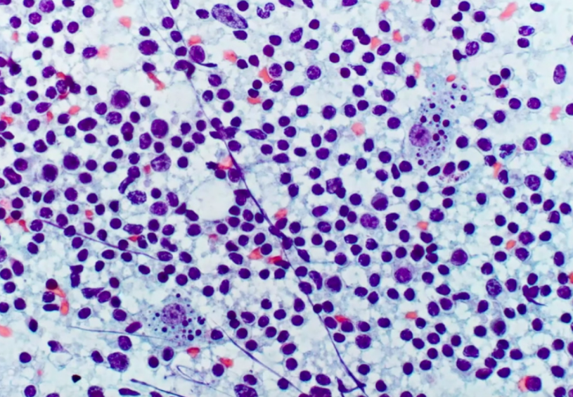 tlabiano's tweet photo. Adenopatías tras vacuna #covid19 #cytopath #PAAF , serie de linfadenitis post vacuna #COVID19 Patrón de hiperplasia folicular con aumento de células B, inmnoblastos, incluso mitosis. ¡CUIDADO! Resultados preliminares del H. Santiago Ramón y Cajal #SEAP2021B https://t.co/nnutCQjSPw