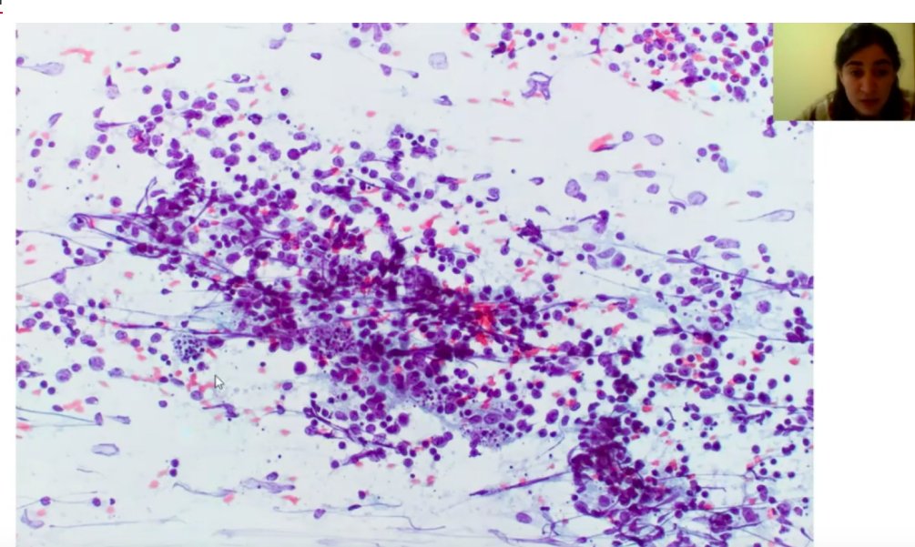 tlabiano's tweet photo. Adenopatías tras vacuna #covid19 #cytopath #PAAF , serie de linfadenitis post vacuna #COVID19 Patrón de hiperplasia folicular con aumento de células B, inmnoblastos, incluso mitosis. ¡CUIDADO! Resultados preliminares del H. Santiago Ramón y Cajal #SEAP2021B https://t.co/nnutCQjSPw