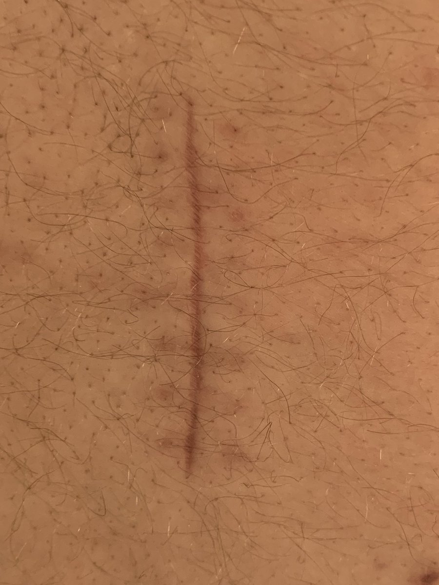 AshSportsPhotos's tweet photo. My scar is now 8 weeks old, it’s growing up so fast 😂
#FixMyBack #BackIsFixed 🚑 https://t.co/YLjhepIKqh
