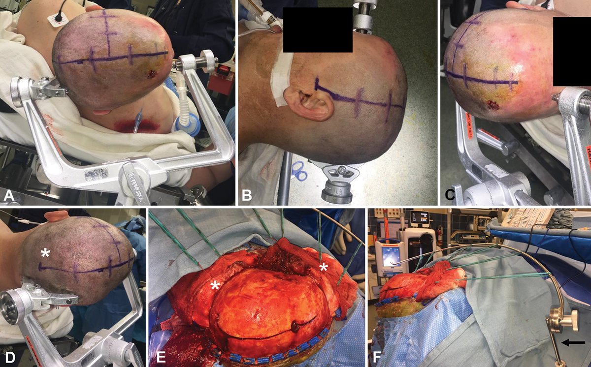 TheJNS's tweet photo. #OnlineFirst: The Kempe incision for decompressive craniectomy, craniotomy, and cranioplasty in traumatic brain injury and stroke https://t.co/jXy9AY2yMS https://t.co/fexoAd0Vc3