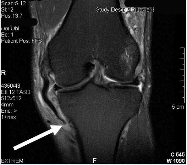 thekneedoc's tweet photo. Are #MCL and #meniscustears the same thing?

While the pain can often be at the joint line for either of these, medial meniscal tears are not common with most MCL injuries and may be present only 10% to 15% of the time. https://t.co/0IO7LngIN7 #orthotwitter #educatethepatient https://t.co/lxqT6Beadc