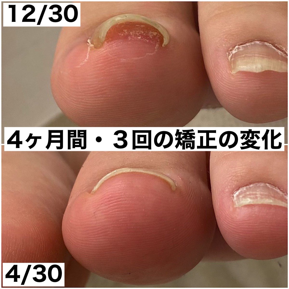 巻き爪サロン Libre Makizumelibre Twitter
