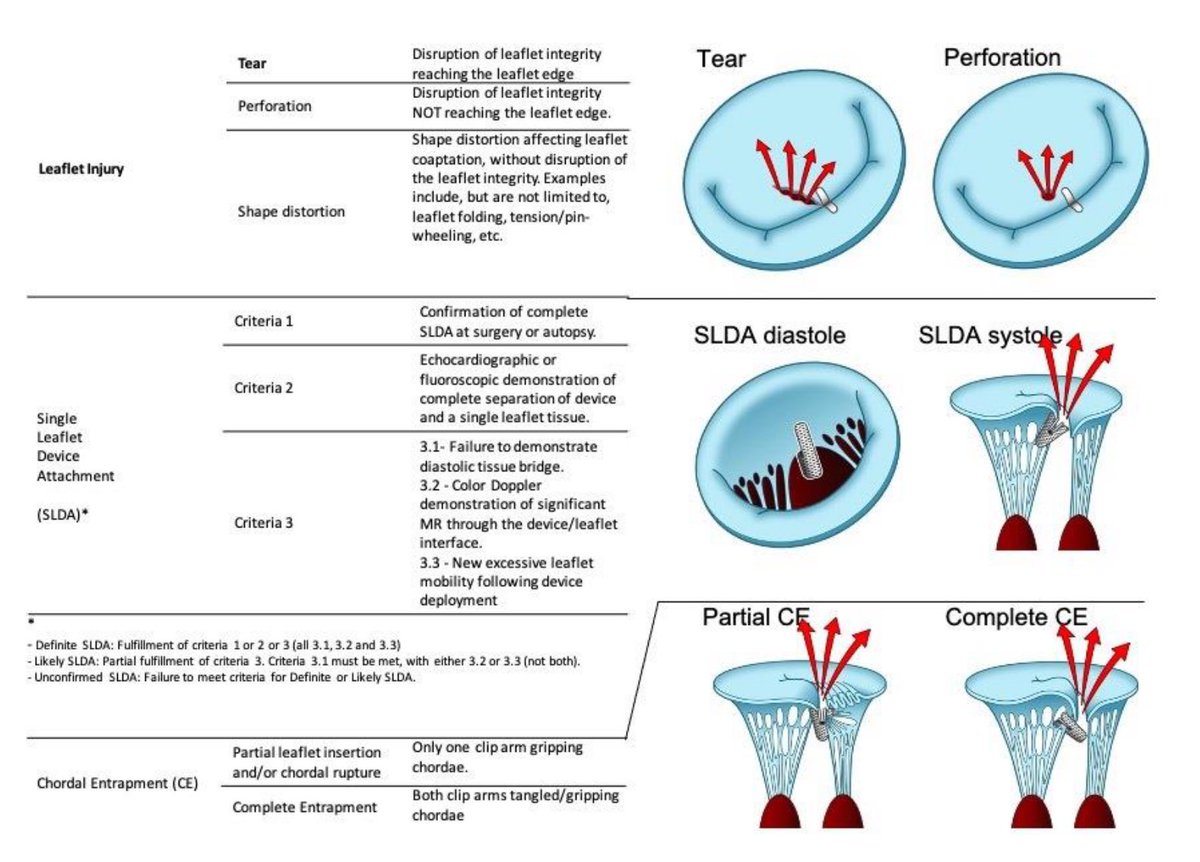 adnanalkhouli's tweet photo. In this 📝 @EuroInterventio, a panel of experts reviewed 35 cases of leaflet tear, perforation, or SLDA &amp;  proposed a standardized definition of leaflet adverse events after TEER. https://t.co/GYaPCgLUZ5 https://t.co/YwBXBVaZOE