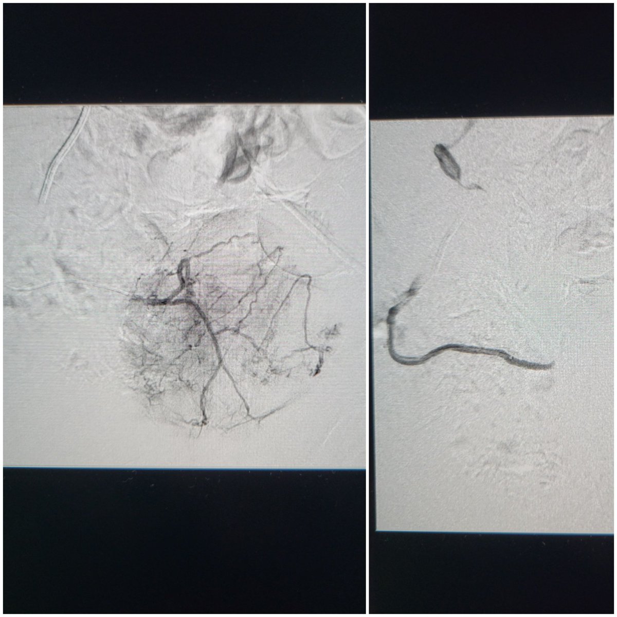 TempleRADs's tweet photo. Patient with obstructive prostatomegaly and suprapubic catheter. Nonoperative candidate due to comorbidities. Bilateral prostate artery embolization by @spratipat, @TamaraFierst, and Nameet Patel, MD. Tough arteries, but great result! @TempleUrology. @SIRRFS @SIR_ECS #IRAD. https://t.co/OlEdvgryt5