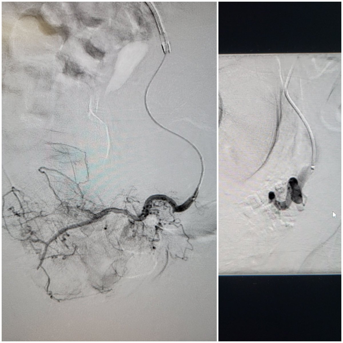 TempleRADs's tweet photo. Patient with obstructive prostatomegaly and suprapubic catheter. Nonoperative candidate due to comorbidities. Bilateral prostate artery embolization by @spratipat, @TamaraFierst, and Nameet Patel, MD. Tough arteries, but great result! @TempleUrology. @SIRRFS @SIR_ECS #IRAD. https://t.co/OlEdvgryt5