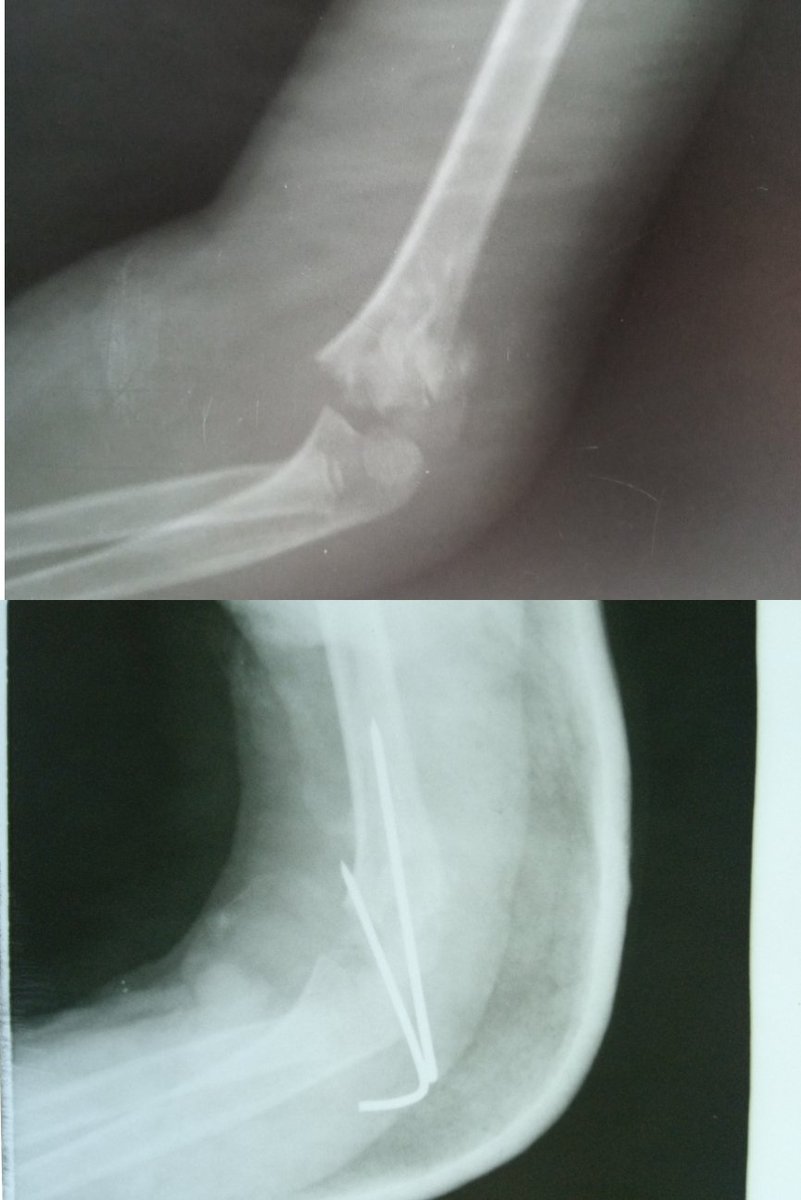 sportsurgeonng's tweet photo. This child had an elbow fracture and was  treated by a local bonesetter for 2 weeks with complications.  Luckily he was brought to us before much damage was done.  We had to do an open reduction and fixation to give the best chance for recovery https://t.co/kiw29XhygN