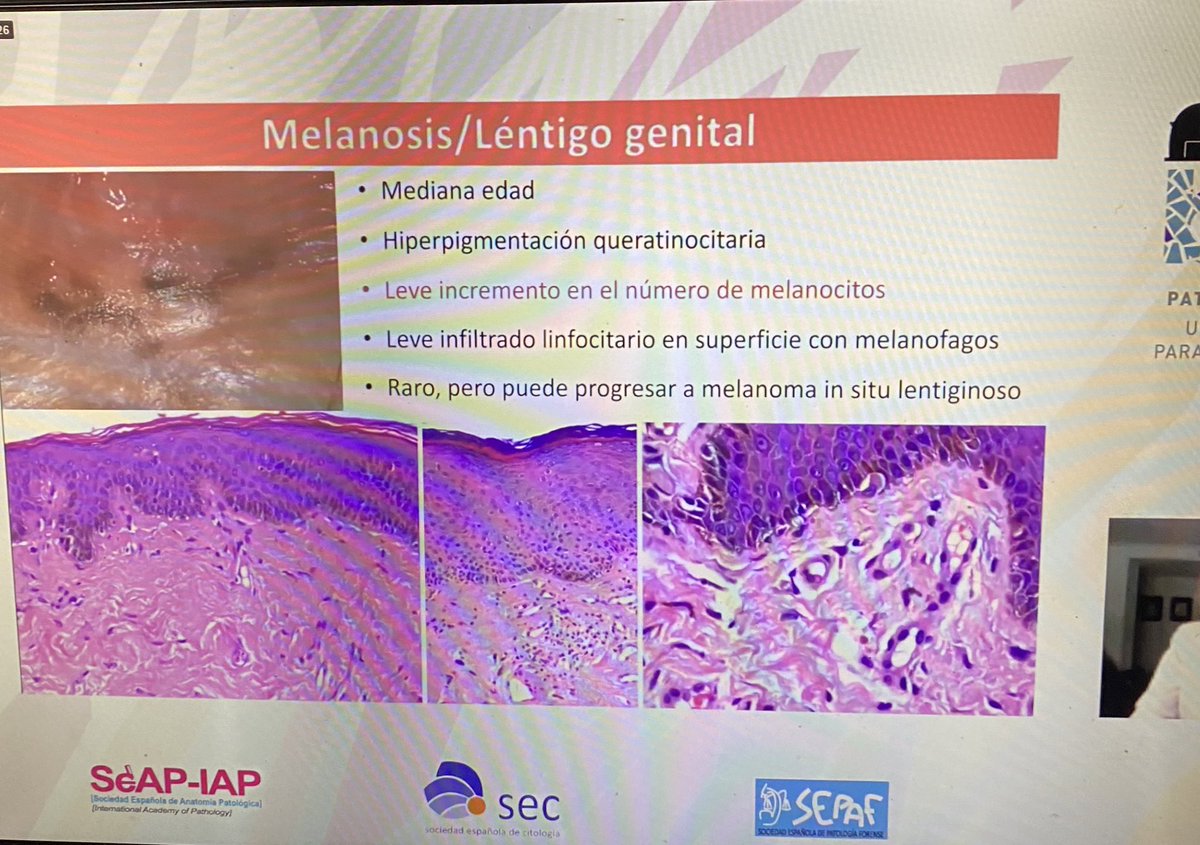 YamaVelasco's tweet photo. @Dermatopatol (Dra Fernandez Figueras) did a really interesting Review on vulvar Pathology #dermpath  #gypath at #SEAP2021B https://t.co/rxpVOBYgNz