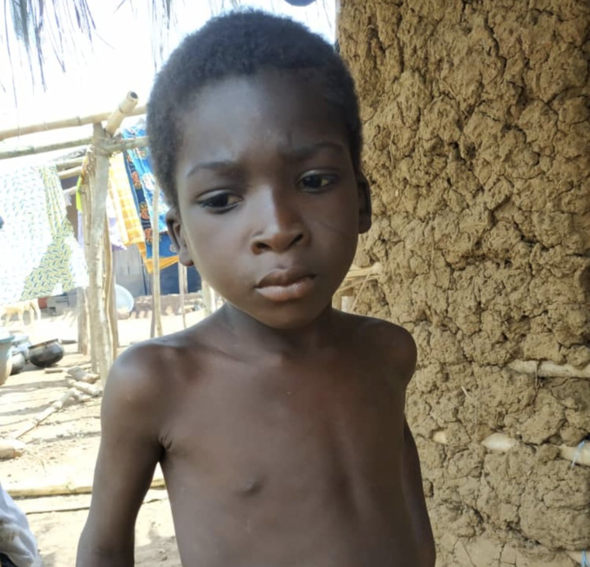 Classical #Yaws case before &amp; after Azithromycin. Enrolled (w consent for photo) <a href="/EDCTP/">EDCTP</a> #LAMP4Yaws project - Great work team Cote d'Ivoire